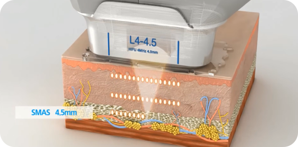 4.5mm 깊이의 SMAS(근막층)에 열응고점 형성